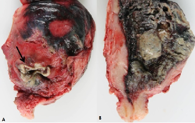 Spontaneous Perforation of Pyometra Resulting in
Peritonitis in a Postmenopausal Woman