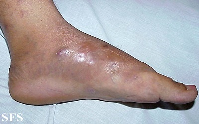 Nocardial Infections: An Under-Diagnosed Malady of Immunocompromised Hosts