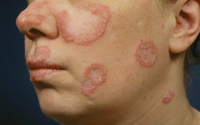 Therapeutic Action Research of Bacille Calmette Guerin (BCG) on a Systemic Lupus
Erythematosus Mouse Model