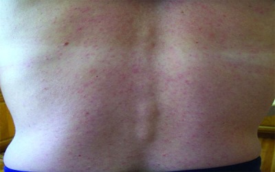 In vitro Inhibition of Zika Virus by MetadicholÂ®, A Novel Nano Emulsion Lipid