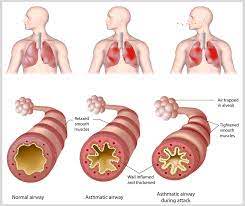 Relationship of Oxidative Stress in Uncontrolled Asthma: A Prospective Study