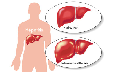 Clinico-Demographic Profile and Status of Hepatitis B Immunization among Chronic Kidney Disease Patients Seeking Tertiary Hospital Care