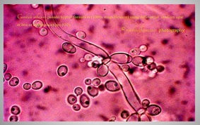 Late-Onset Prosthetic Valve
Fungal Endocarditis due to
Candida albicans: A Case Report
and Review of Literature from
India