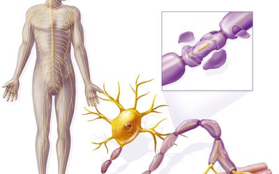 Prospect of CD52 Targeted
Alemtuzumab in Treatment of
CNS Demyelination in Multiple
Sclerosis