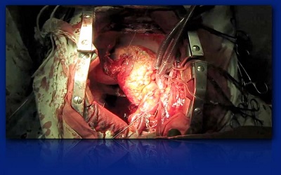 Hypertrophic Pulmonary
Osteoarthropathy: Images with
Significant Changes Post Lung
Tumor Resection