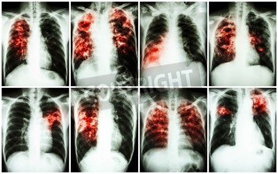 Endogenous Reactivation and
Exogenous Re-infection by Beijing
Clade Isolated from Pulmonary
Tuberculosis Patients in Sikkim,
India