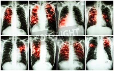 Endogenous Reactivation and
Exogenous Re-infection by Beijing
Clade Isolated from Pulmonary
Tuberculosis Patients in Sikkim,
India