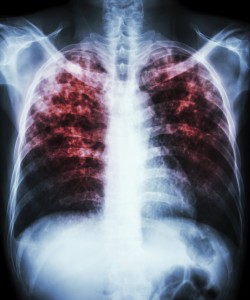 Treatment and Management of Latent Tuberculosis Infection in Lethargic Patient