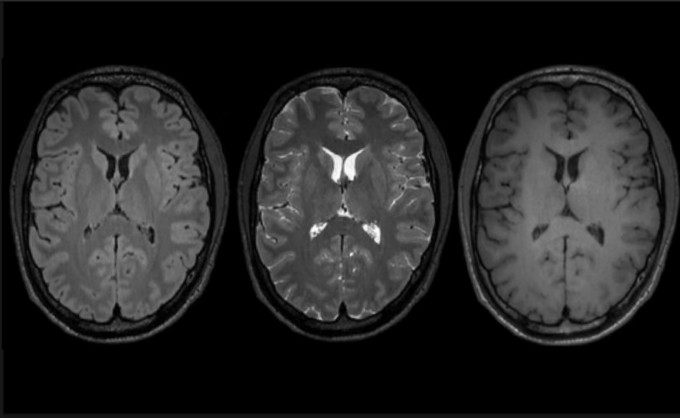 Improving Parallel Imaging by Jointly Reconstructing Multi- Contrast Data