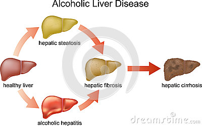 Defining Single Nucleotide Polymorphic (SNP) Variants Role of Human Angiotensinogen in Liver Fibrosis