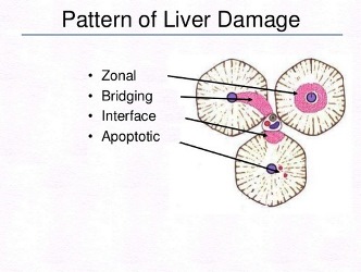 Clinical Profile of Autoimmune Hepatitis Among Filipino patients