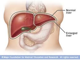 Enormous Hepatic Cysts in
Polycystic Kidney Disease
