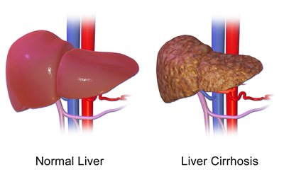 Scientific Publications Regarding Liver Cirrhosis and Portal Hypertension in 6 Science Citation Index Hepatology Specialized Journals from 2009 To 2011
