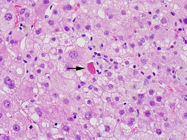 Hepatic Cell Necrosis Patterns