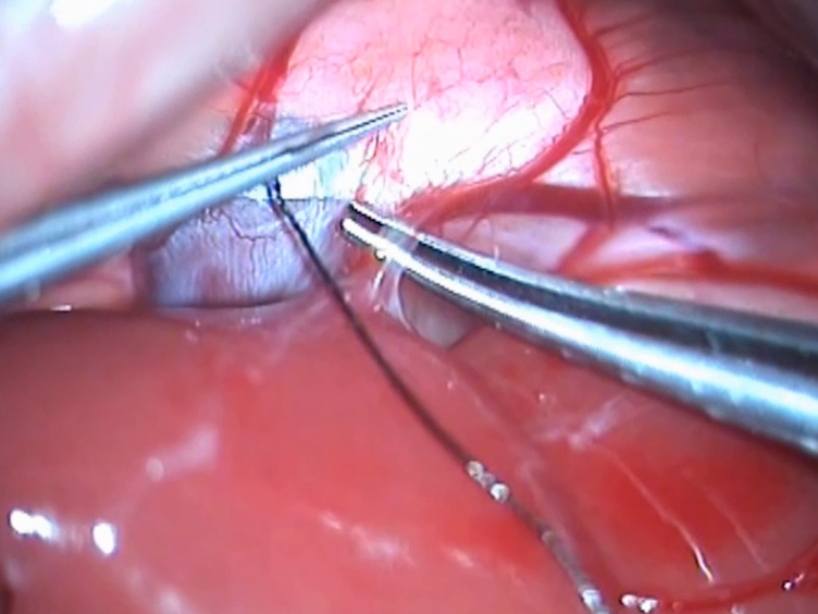 Portal Vein Ligation for Staged Hepatectomy in a Rat Model of Liver