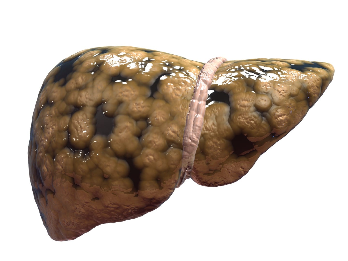 Non-alcoholic Fatty Liver Disease (NAFLD): Fatty Liver  Illness