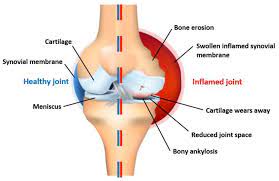 Muscular Embed is a Clinical Gadget Produced to Supplant a Missing Joint