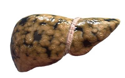 Analysis of Methylation and Expression Profiles of CPT1-A and APOE Genes in Patients with NAFLD