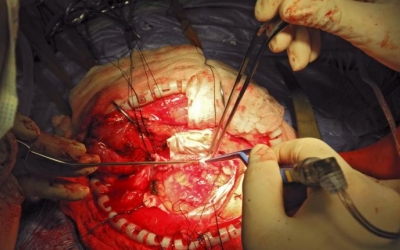 A New Pig Model of Auxiliary Partial Liver Transplantation Based on Anastomosis with Intrahepatic Inferior Vena Cava of Recipient