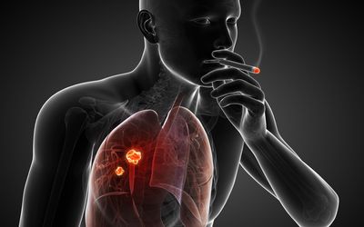 A Case of Resected Cholangiolocellular Carcinoma
during Treatment for Lung Cancer