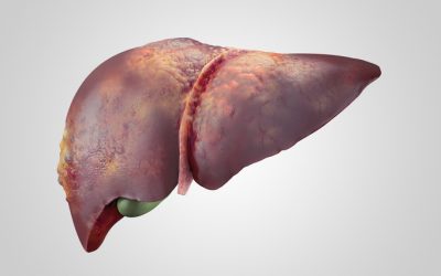 Nonalcoholic Fatty Liver Disease (NAFLD) after Liver Transplantation: A Mini-Review