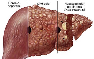 Prevalence of Vitamin D Deficiency among Non-cirrhotic Pakistani Patients with Chronic Viral Hepatitis and Non-alcoholic Fatty Liver Disease