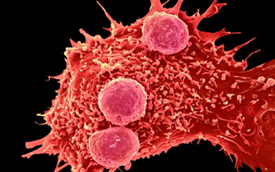 Cancer Associated Fibroblasts and Hepatocellular Carcinoma