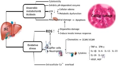 Dilemma of Hepatic Ischemia Reperfusion Injury after Liver Transplantation