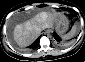 Acute Liver Failure and Concomitant Severe Acute Pancreatitis Due to Hepatitis B: Successful Management with Liver Transplantation