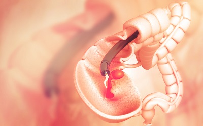 â€˜You Ainâ€™t Going in Thereâ€™: Patient Perceived Promoters and Barriers to Colonoscopy Screening in an Urban Population, Baltimore, Maryland