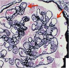 Pathophysiological Advances in Membranous Nephropathy