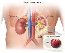 A Retrospective Study of Body Mass Index, Cigarette Smoking and Hypertension, was the Danger of Renal Cell Carcinoma (Yemen)