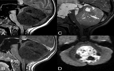 Pediatric Embryonal Tumors in
True Rosettes (Etmrs) Presenting
as a Low Grade Gliomaâ€“ An
Unusual Case Report