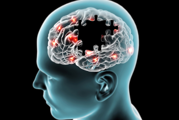 Neurodegeneration - Neurodegenerative Diseases