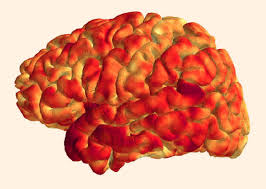 Brain stroke in early 50â€™s
