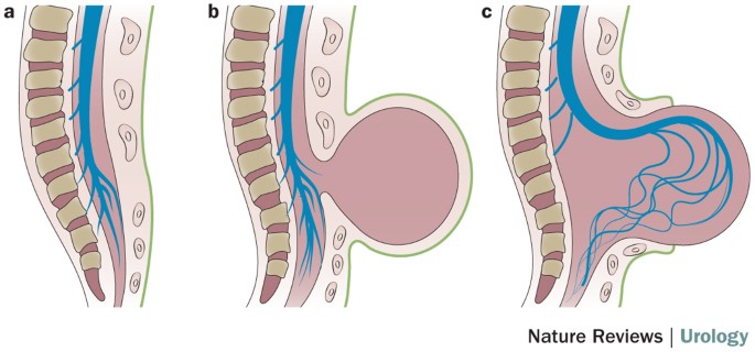 A Clinical Study of Spinal Dysraphism Cases in Tertialy Care Center, Kakinada, Andhra Pradesh