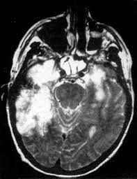 A Rare Case of Anti-Nmda Receptor Encephalitis with Ovarian Teratoma in the Setting of Vzv Encephalitis