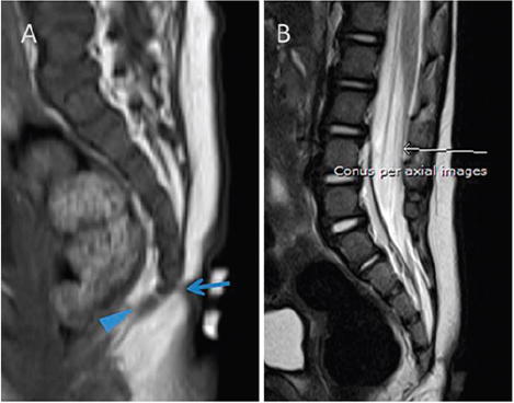 Review on Tropical Heamonchoisis in Sheep and Goats and Diagnositic Techniques, Famacha and Postmortem Adult Parasitic Count, Treatment, Prevention and Control