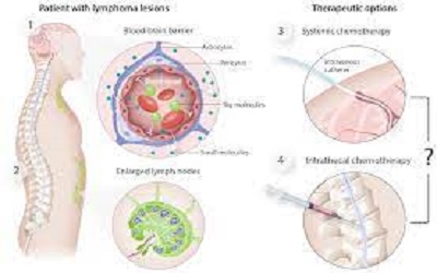 Delivery System to Inhibit Central Nervous System Lymphoma