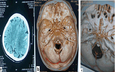 Assessment of Endovascular Coiling versus Neurosurgical Clipping of Intracranial
Aneurysms in Patients with Subarachnoid Hemorrhage