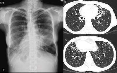 Neuroboriellosis and Associated Myoclonus in a Patient with Kartegenerâ€™s Syndrome