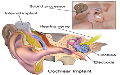 Biological Mechanism of Cochlear Implant Technology in Humans