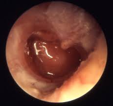 A Study of Clinical Profile in Chronic Otitis Media (Mucosal Type)