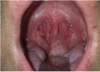 Kurkure Throat: A New Clinical Entity?