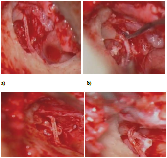 Anatomical Variation-Notch in Long Process of Incus Due to Chorda Tympani Nerve in Two Cases