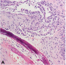 Skull Base Metastasis from Follicular Thyroid Carcinoma: A Case Report and Review of the Literature