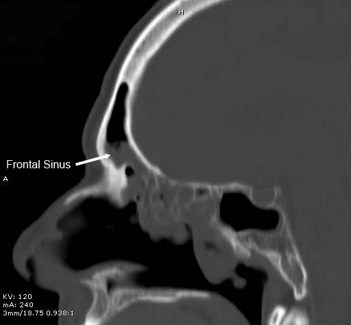 Complications of Frontal Sinusitis