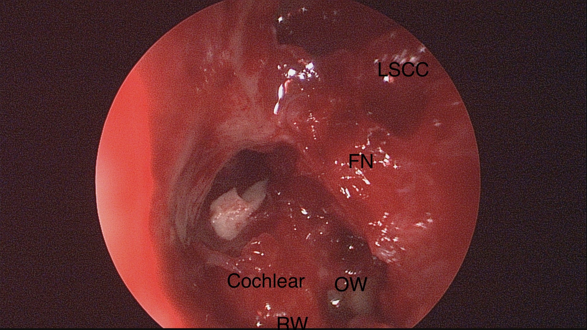 Endoscopic Transcanal Approach to Remove Extensive Petrous Cholesteatoma