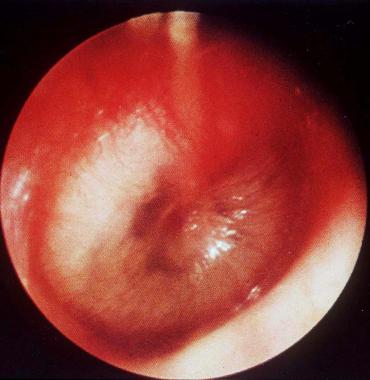 The Effect of Desloratadine on Chronic Otitis Media with Effusion in Children Requiring Grommet