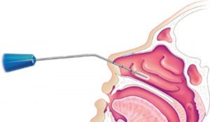 Epiphora after Inferior Turbinate Surgery